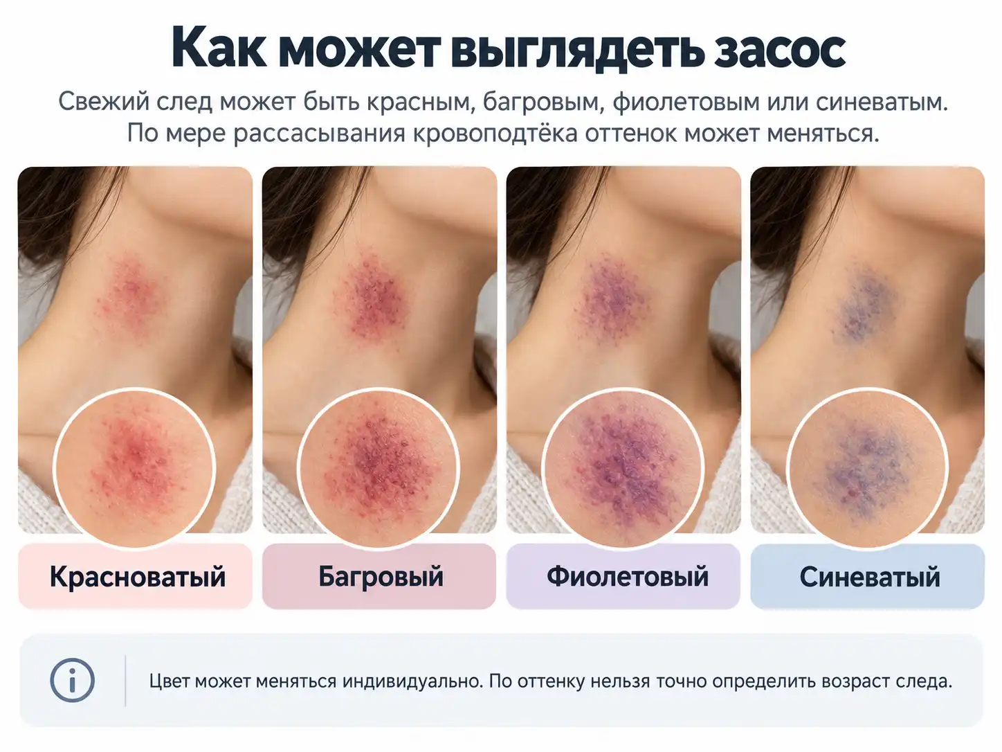 Иллюстрация к материалу о засосе